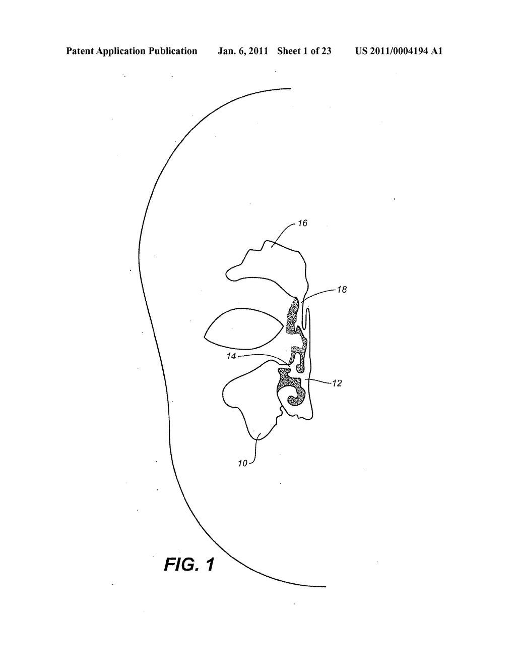 DEVICE AND METHODS FOR TREATING PARANASAL SINUS CONDITIONS - diagram, schematic, and image 02