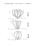 DEVICE AND METHODS FOR TREATING PARANASAL SINUS CONDITIONS diagram and image