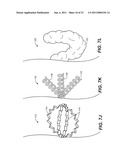 DEVICE AND METHODS FOR TREATING PARANASAL SINUS CONDITIONS diagram and image