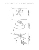 DEVICE AND METHODS FOR TREATING PARANASAL SINUS CONDITIONS diagram and image