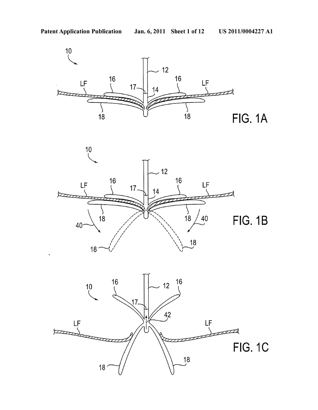 FIXATION DEVICES FOR VARIATION IN ENGAGEMENT OF TISSUE - diagram, schematic, and image 02