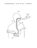 Systems and Methods for Treating Obesity and Type 2 Diabetes diagram and image