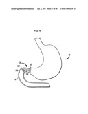 Systems and Methods for Treating Obesity and Type 2 Diabetes diagram and image