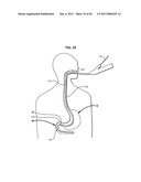 Systems and Methods for Treating Obesity and Type 2 Diabetes diagram and image