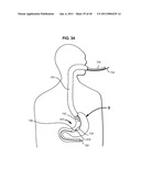 Systems and Methods for Treating Obesity and Type 2 Diabetes diagram and image