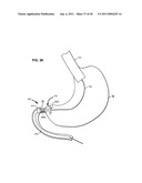 Systems and Methods for Treating Obesity and Type 2 Diabetes diagram and image