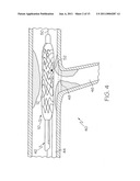 Bifurcated Stent and Delivery System diagram and image