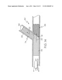 Bifurcated Stent and Delivery System diagram and image