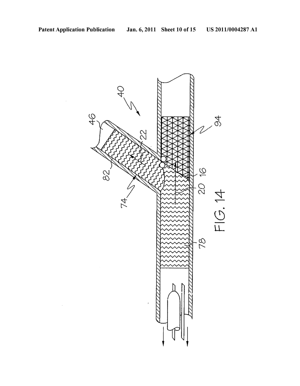 Bifurcated Stent and Delivery System - diagram, schematic, and image 11