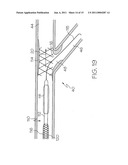 Bifurcated Stent and Delivery System diagram and image