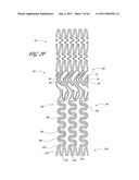 OSTIUM SUPPORT FOR TREATING VASCULAR BIFURCATIONS diagram and image