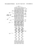 OSTIUM SUPPORT FOR TREATING VASCULAR BIFURCATIONS diagram and image