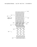 OSTIUM SUPPORT FOR TREATING VASCULAR BIFURCATIONS diagram and image