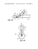 OSTIUM SUPPORT FOR TREATING VASCULAR BIFURCATIONS diagram and image