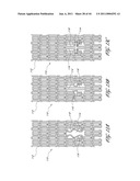 OSTIUM SUPPORT FOR TREATING VASCULAR BIFURCATIONS diagram and image