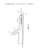 OSTIUM SUPPORT FOR TREATING VASCULAR BIFURCATIONS diagram and image