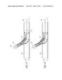 OSTIUM SUPPORT FOR TREATING VASCULAR BIFURCATIONS diagram and image