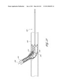 OSTIUM SUPPORT FOR TREATING VASCULAR BIFURCATIONS diagram and image