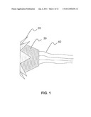 Heart Valve Stent diagram and image