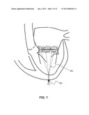 Heart Valve Stent diagram and image