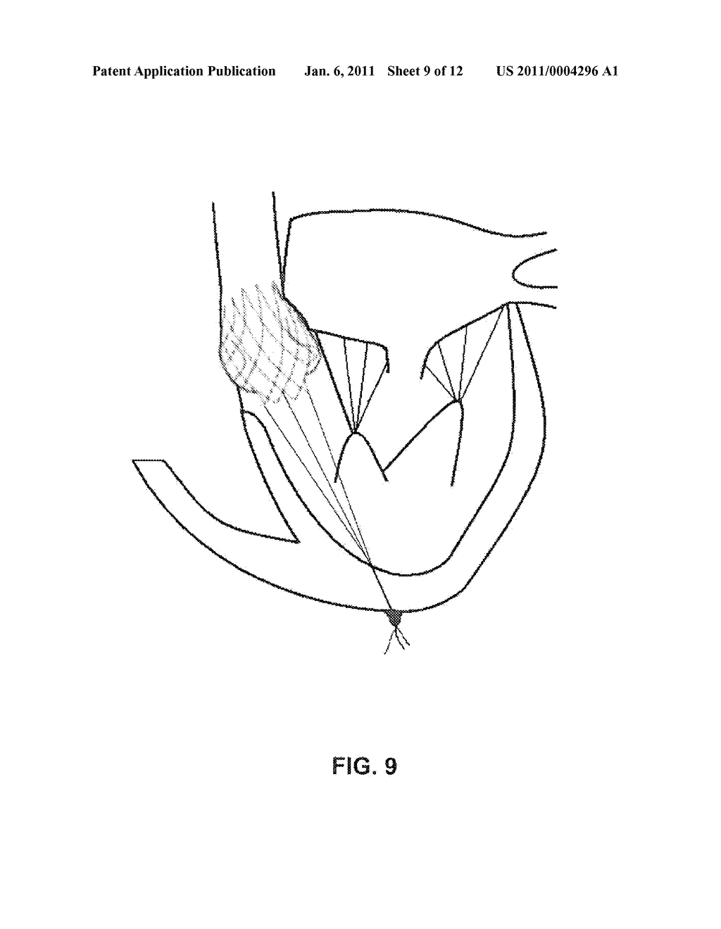 Heart Valve Stent - diagram, schematic, and image 10