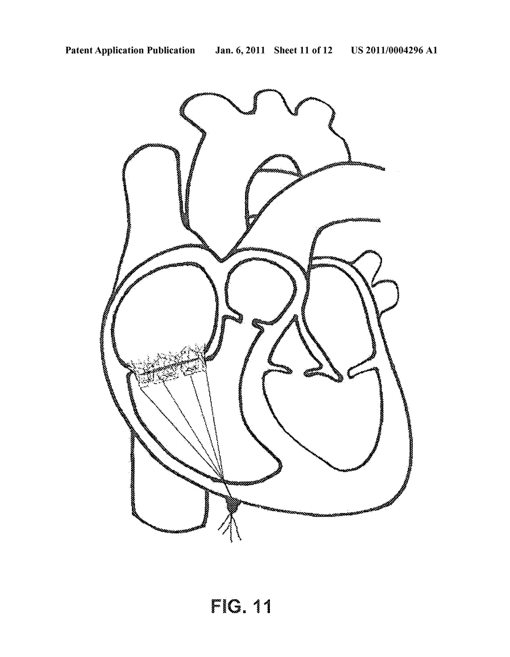 Heart Valve Stent - diagram, schematic, and image 12