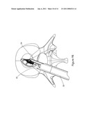 Intervertebral Spacer diagram and image