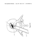 Intervertebral Spacer diagram and image