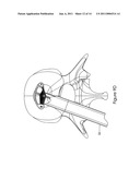 Intervertebral Spacer diagram and image