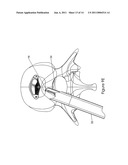 Intervertebral Spacer diagram and image