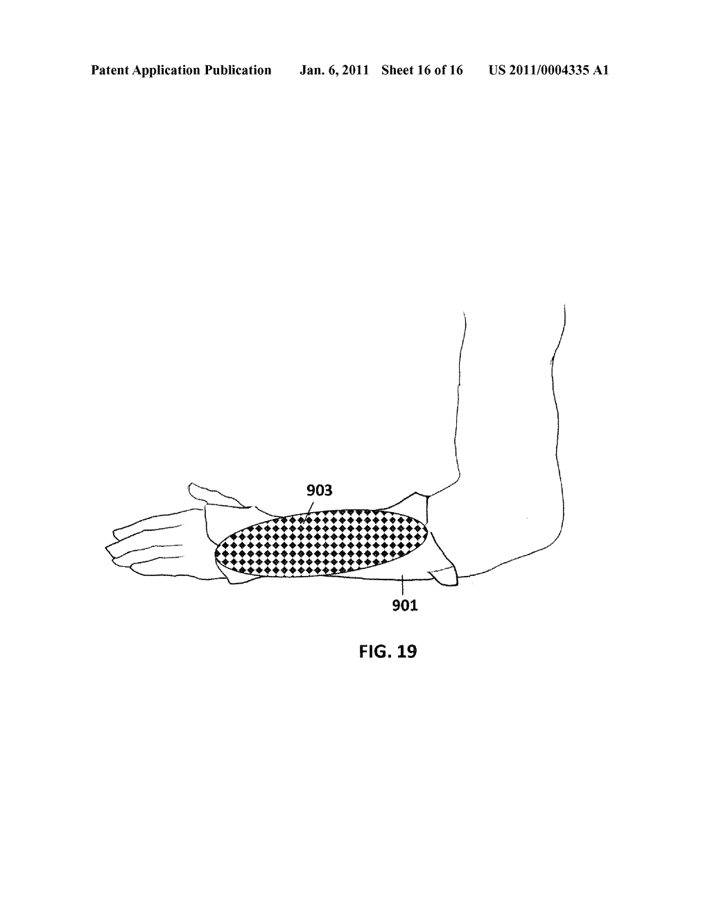 REPLACEABLE FAIRING FOR PROSTHETIC LIMB OR BRACE - diagram, schematic, and image 17