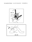 IMAGE GUIDED HIGH INTENSITY FOCUSED ULTRASOUND TREATMENT OF NERVES diagram and image