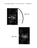 IMAGE GUIDED HIGH INTENSITY FOCUSED ULTRASOUND TREATMENT OF NERVES diagram and image