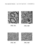 IMAGE GUIDED HIGH INTENSITY FOCUSED ULTRASOUND TREATMENT OF NERVES diagram and image