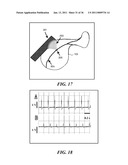 IMAGE GUIDED HIGH INTENSITY FOCUSED ULTRASOUND TREATMENT OF NERVES diagram and image