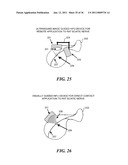 IMAGE GUIDED HIGH INTENSITY FOCUSED ULTRASOUND TREATMENT OF NERVES diagram and image