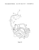 Respiration Rate Trending for Detecting Early Onset of Worsening Heart Failure diagram and image