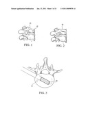 apparatus for spinal fusion diagram and image