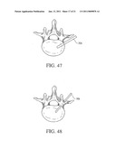 apparatus for spinal fusion diagram and image