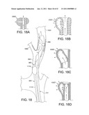 ROTATIONAL ATHERECTOMY SYSTEM WITH ENHANCED DISTAL PROTECTION CAPABILITY AND METHOD OF USE diagram and image