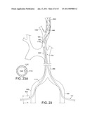 ROTATIONAL ATHERECTOMY SYSTEM WITH ENHANCED DISTAL PROTECTION CAPABILITY AND METHOD OF USE diagram and image