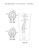 ROTATIONAL ATHERECTOMY SYSTEM WITH ENHANCED DISTAL PROTECTION CAPABILITY AND METHOD OF USE diagram and image