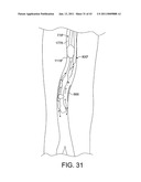 ROTATIONAL ATHERECTOMY SYSTEM WITH ENHANCED DISTAL PROTECTION CAPABILITY AND METHOD OF USE diagram and image