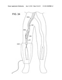 ROTATIONAL ATHERECTOMY SYSTEM WITH ENHANCED DISTAL PROTECTION CAPABILITY AND METHOD OF USE diagram and image