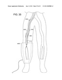 ROTATIONAL ATHERECTOMY SYSTEM WITH ENHANCED DISTAL PROTECTION CAPABILITY AND METHOD OF USE diagram and image