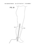 ROTATIONAL ATHERECTOMY SYSTEM WITH ENHANCED DISTAL PROTECTION CAPABILITY AND METHOD OF USE diagram and image