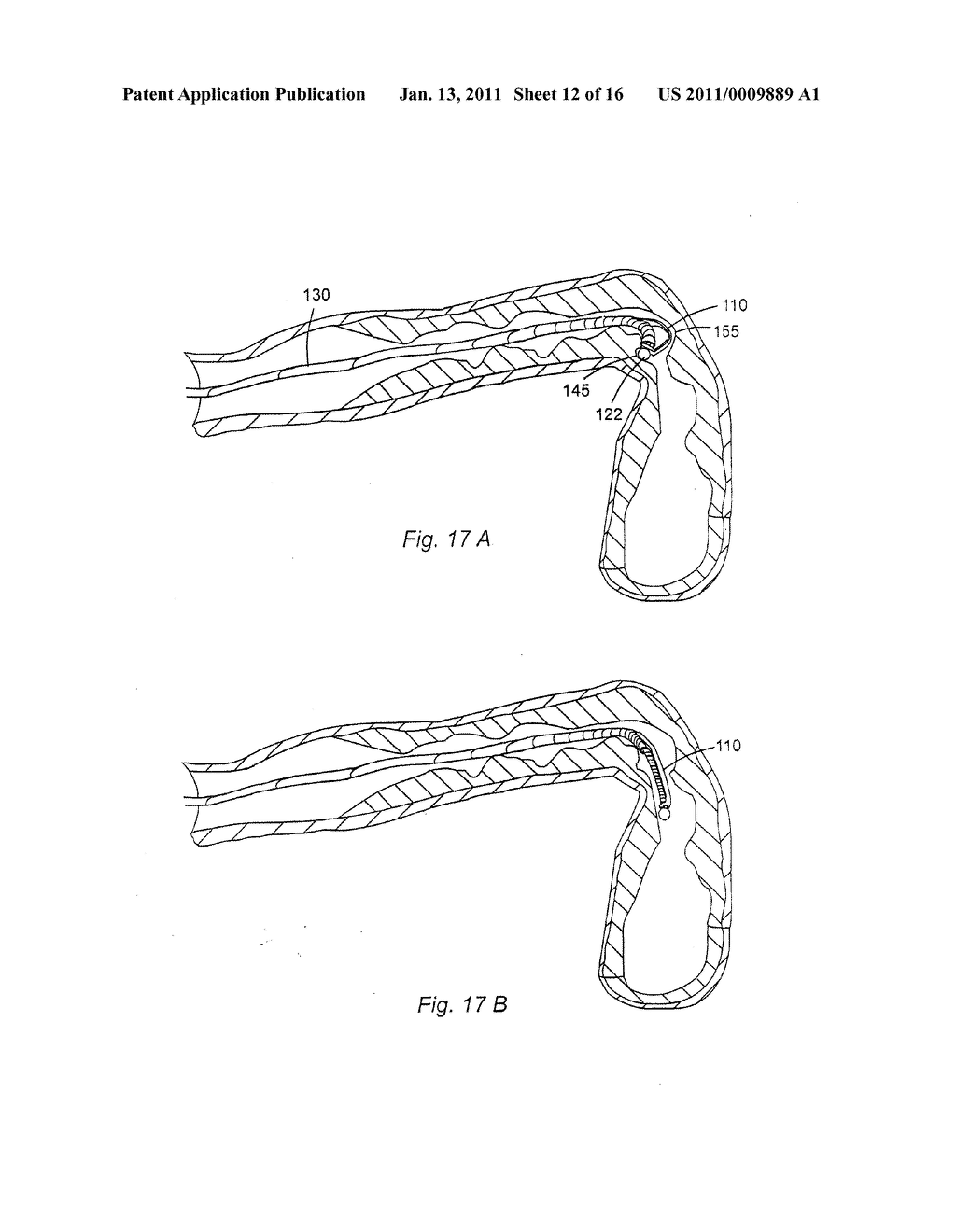 BLOOD VESSEL OCCLUSION AUGER - diagram, schematic, and image 13