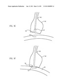 Methods and Devices to Treat Obesity diagram and image