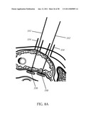 Methods and Devices to Treat Obesity diagram and image