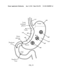 Methods and Devices to Treat Obesity diagram and image